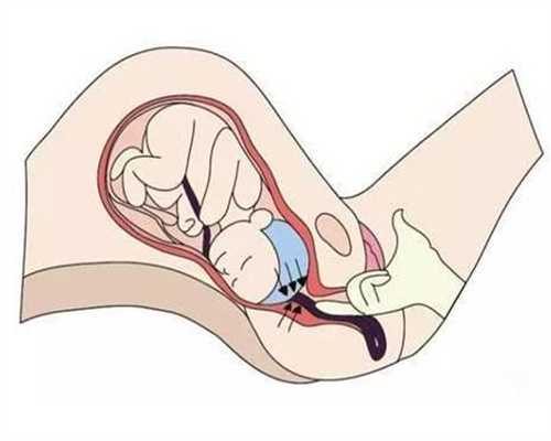 北京代孕不孕咨询_孕晚期胎儿臀位能变成头位吗